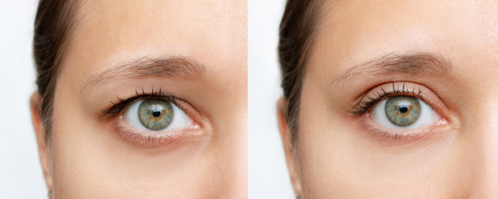 Blefaroplastyka powiek g&oacute;rnych &ndash; Fraxx lub laser CO₂