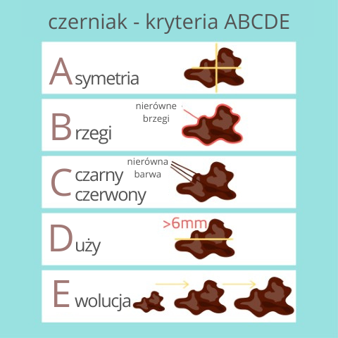 Zasada ABCDE – cechy znamienia wymagające konsultacji lekarskiej