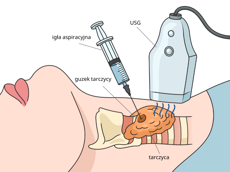 Przebieg biopsji aspiracyjnej cienkoigłowej tarczycy