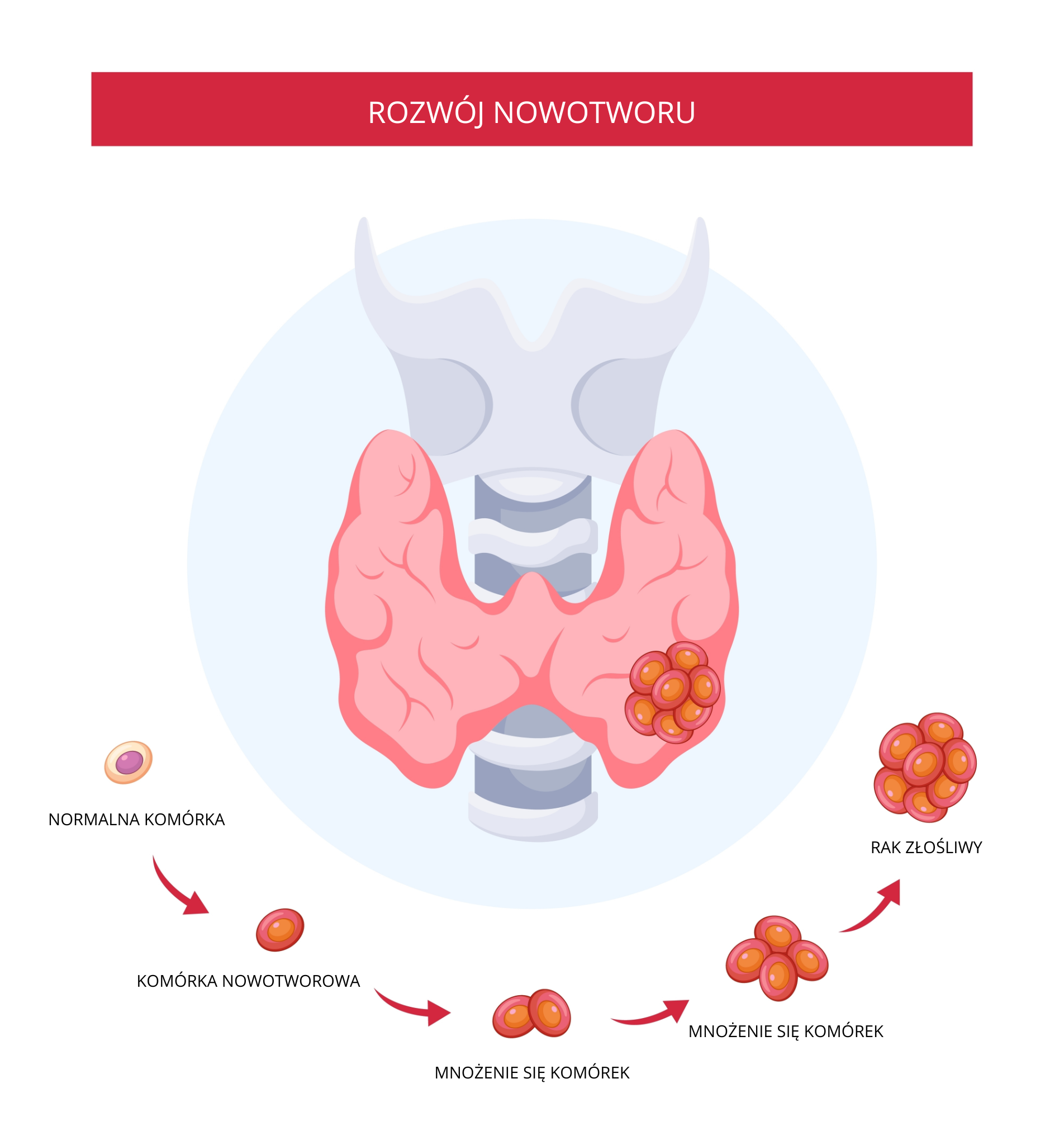 Diagram illustrating the development of a thyroid tumour