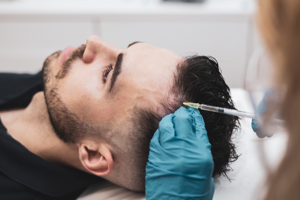 Peptide scalp mesotherapy for selected hair concerns