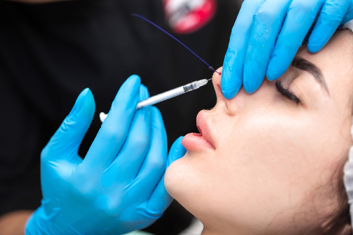 Non-surgical nose reshaping with hyaluronic acid