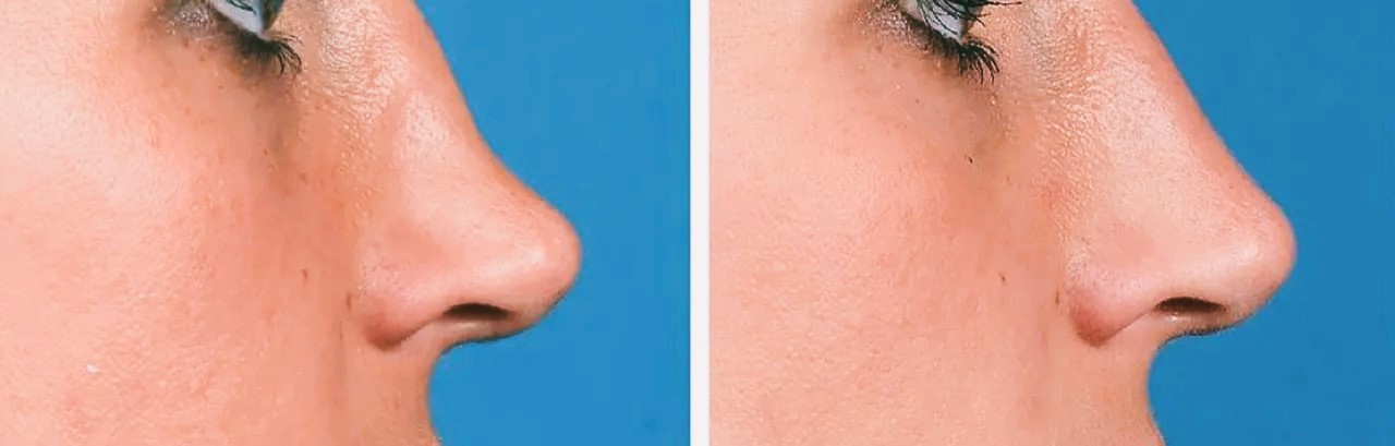Non-surgical nose reshaping with hyaluronic acid