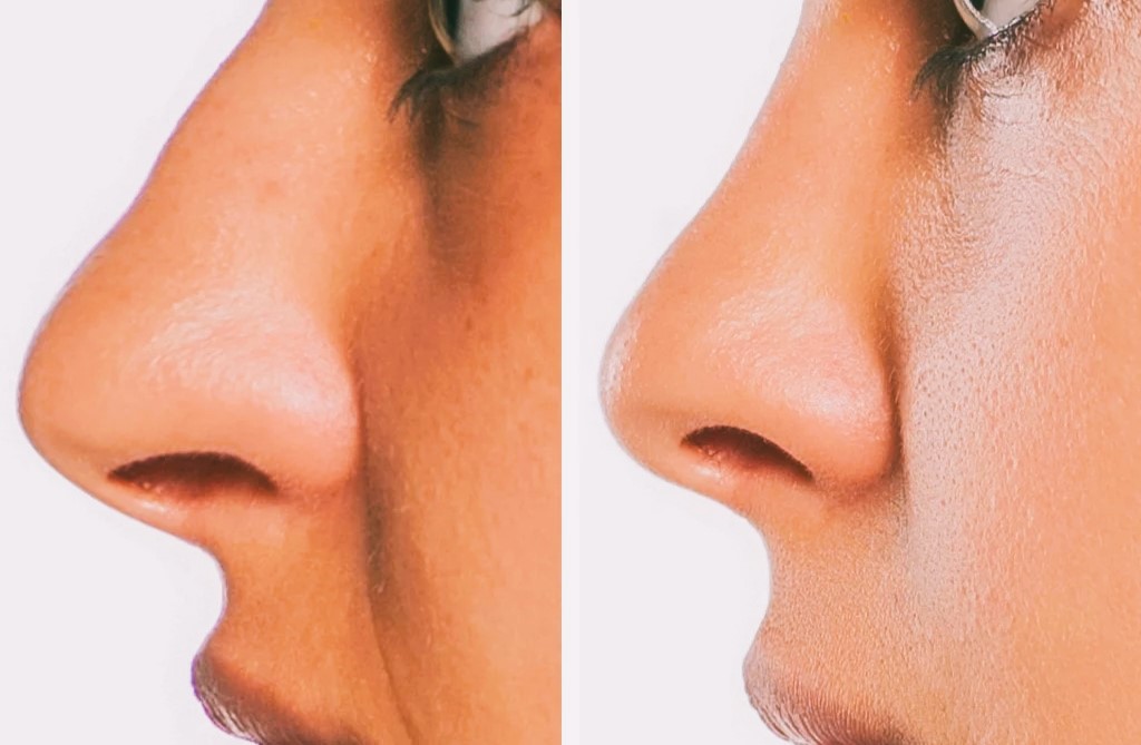 Non-surgical nose reshaping with hyaluronic acid