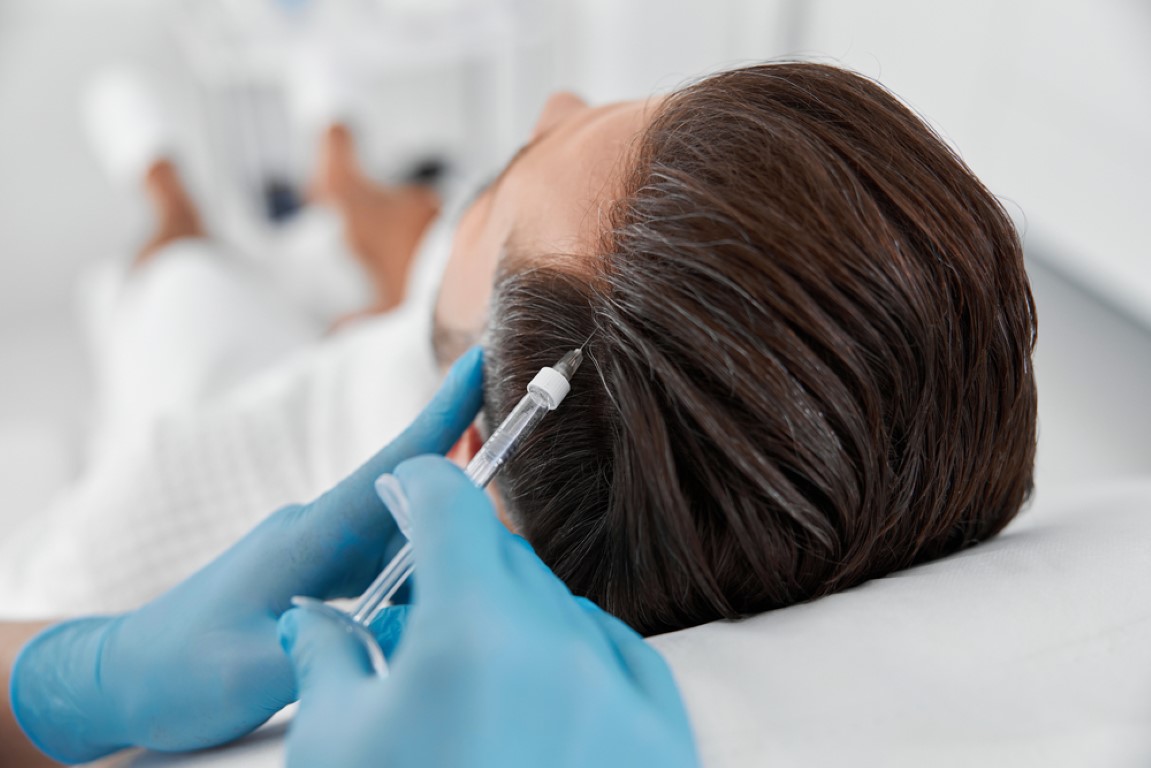 Platelet-rich plasma injections for hair loss