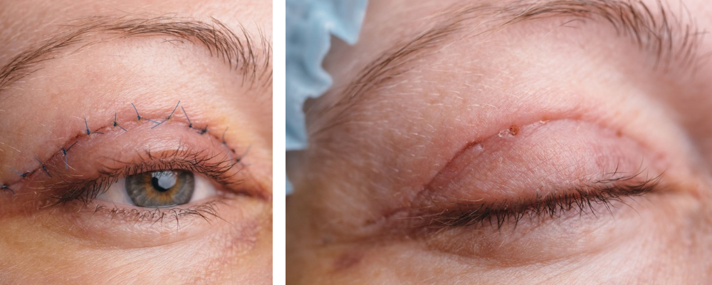 Blefaroplastyka powiek górnych – Fraxx lub laser CO₂