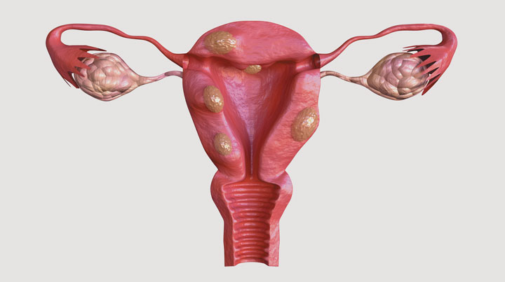 Test EndoRNA na endometriozę w Gdańsku
