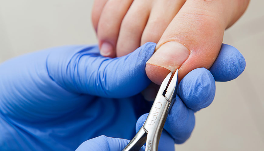 Ingrown toenail treatment in Gdańsk