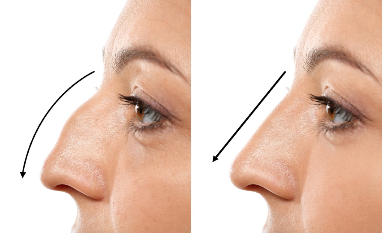Non-surgical nose reshaping with hyaluronic acid